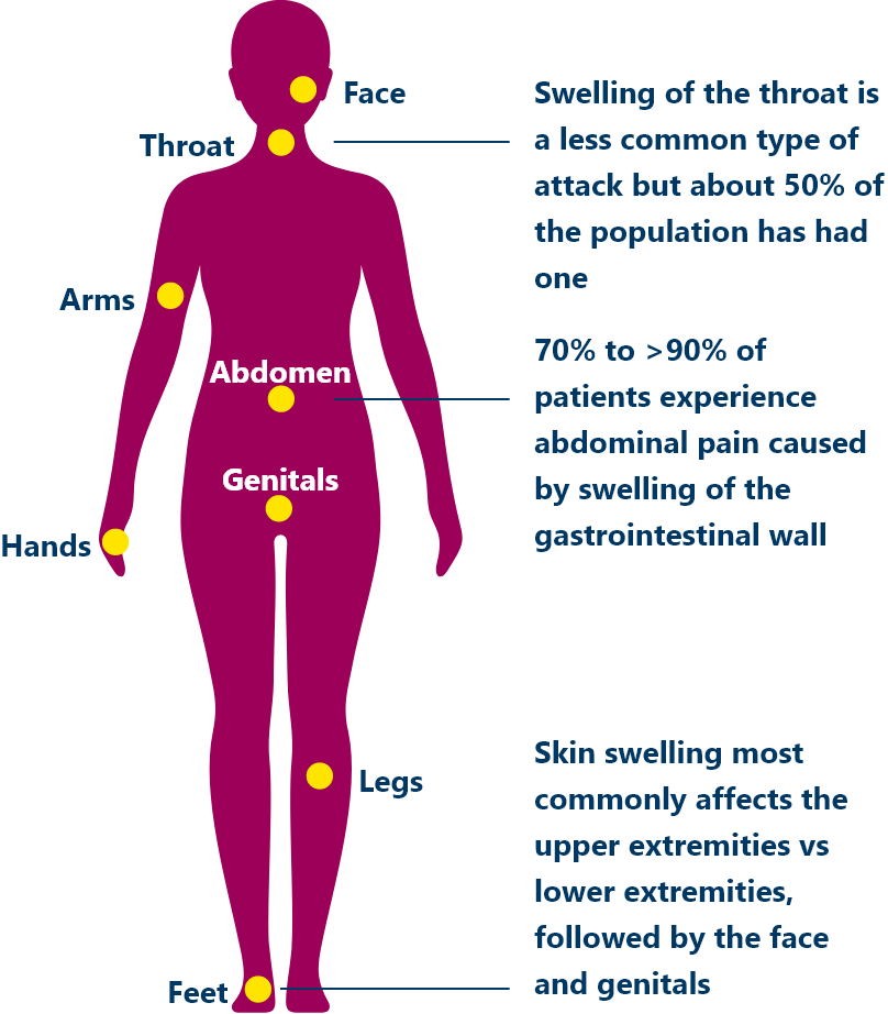 How HAEGARDA Helps Treat HAE Attacks | HAEGARDA®